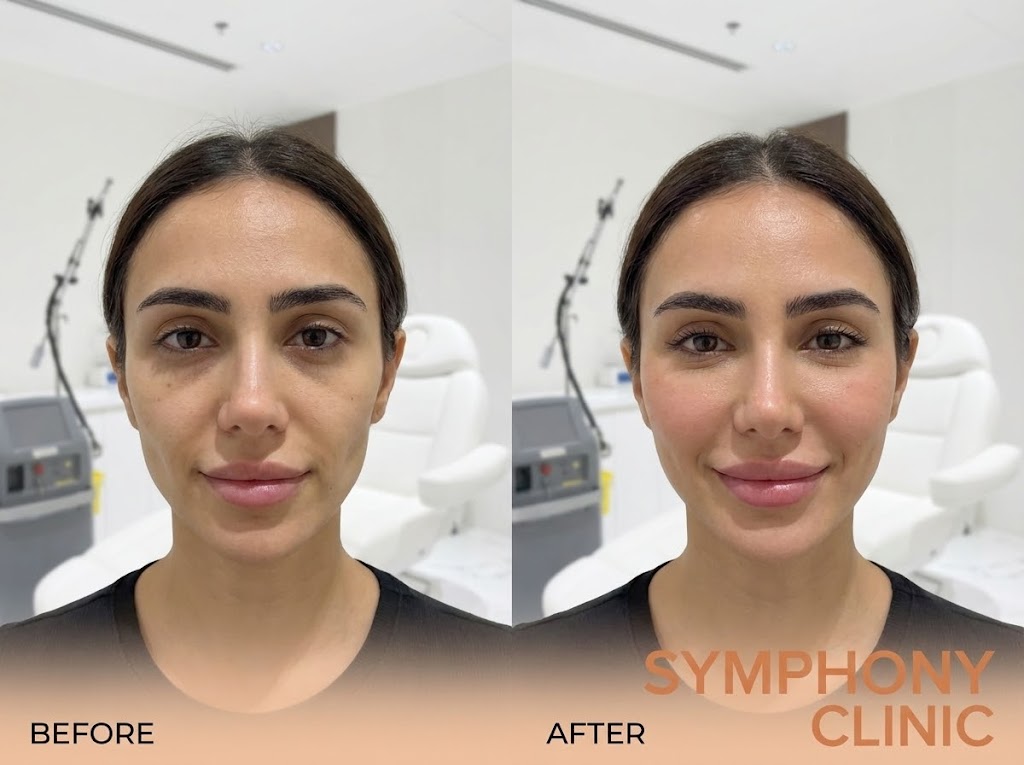 Under-eye Filler Before and After at Symphony Clinic Dubai