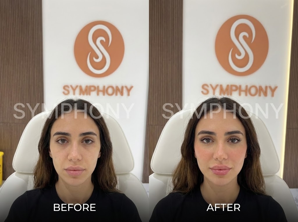 Cheek Filler Before and After at Symphony Clinic Dubai