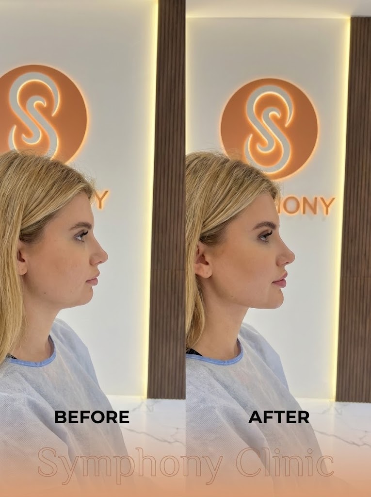 Chin Filler Before and After at Symphony Clinic Dubai