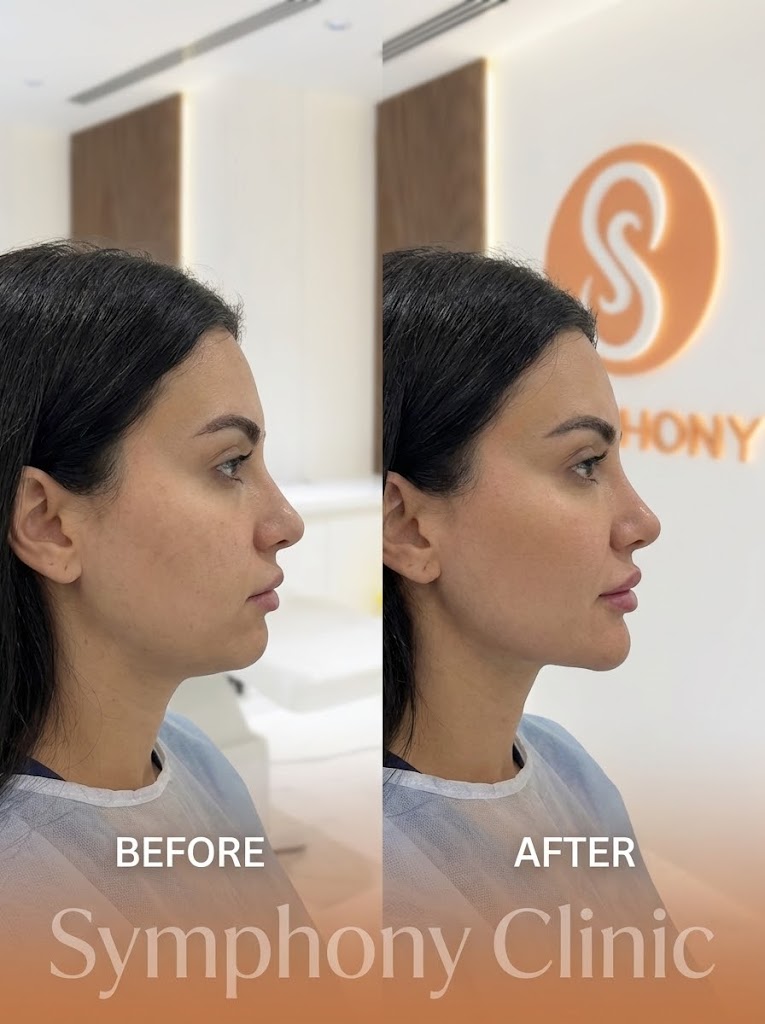 Jawline Filler Before and After at Symphony Clinic Dubai