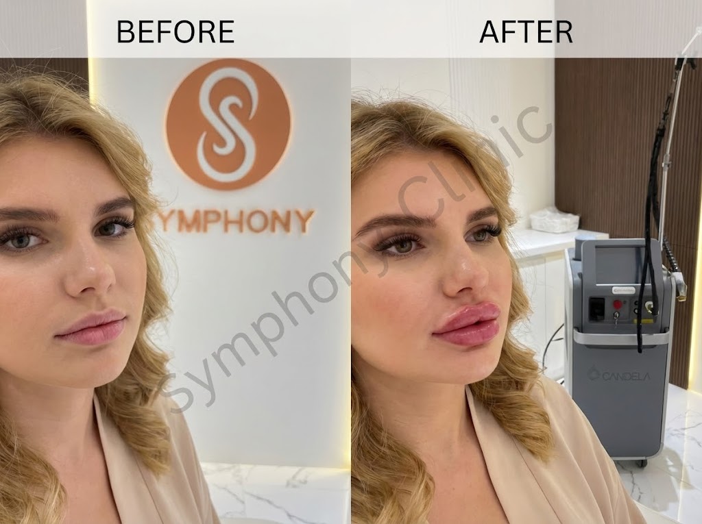 Lip Filler Before and After - Fuller lips at Symphony Clinic Dubai