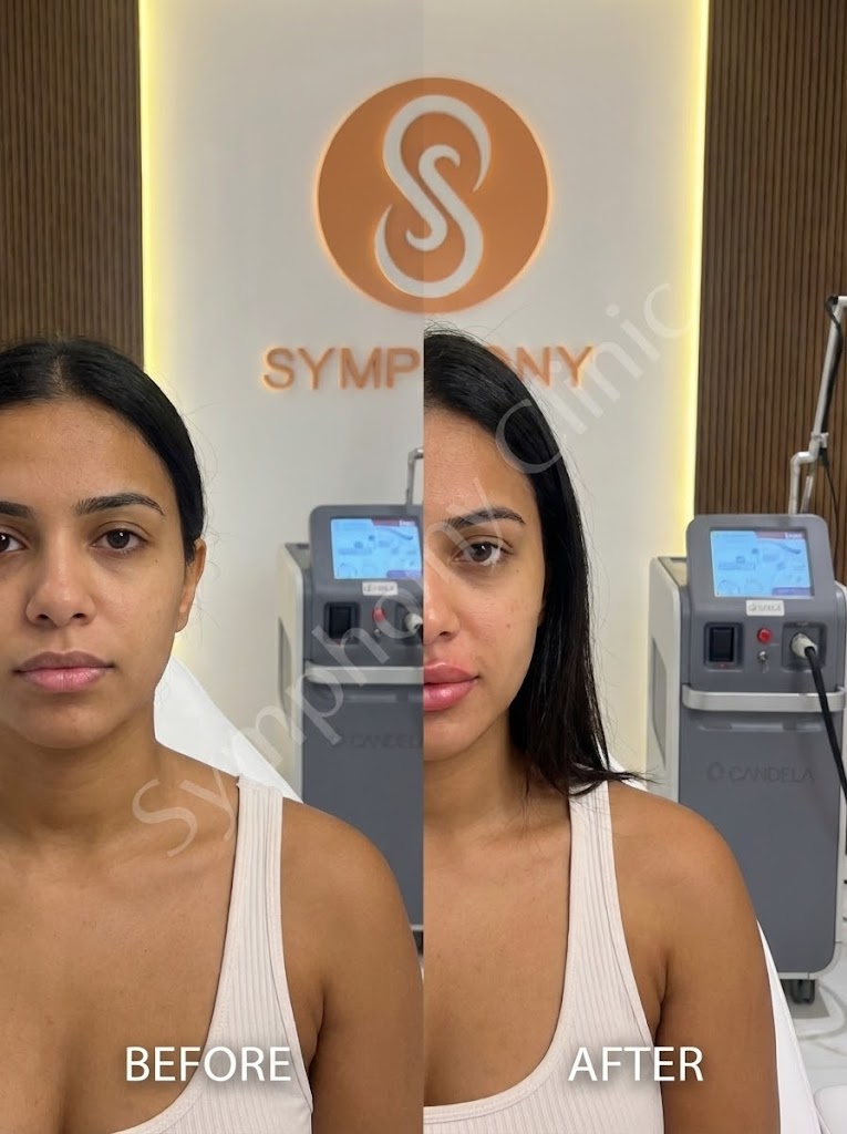 Lip Filler Before and After - Balanced enhancement at Symphony Clinic Dubai
