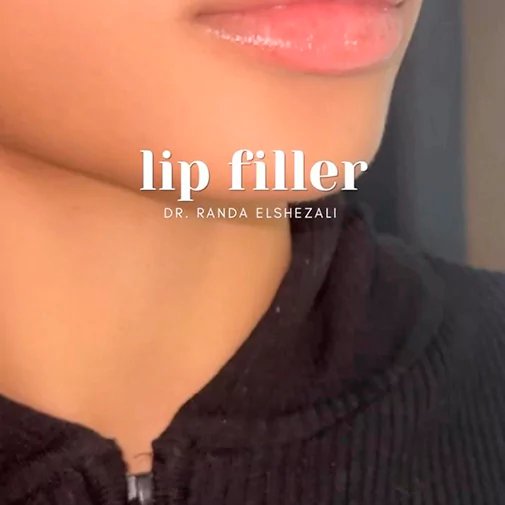 Symphony Clinic Dubai Instagram - lip filler reel